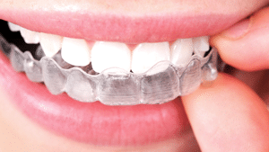 Clear Braces, Tooth-Colored Brackets in Milwaukee WI, Beloit WI, and  Roscoe IL