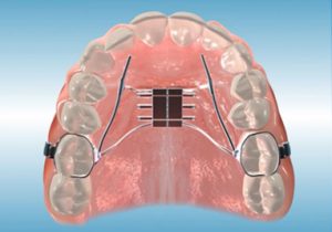 app-palatal