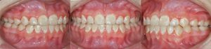 decalcification-orthodontie-sherbrooke-113152-KM