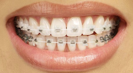 white metal braces