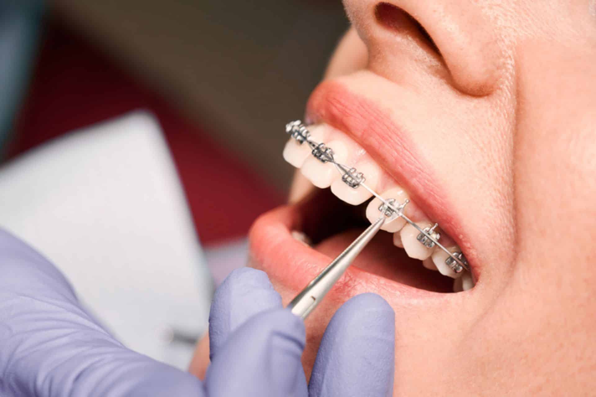 What to Expect During Your Braces Treatment Flanagan Orthodontics in Rockford and Winnebago, IL